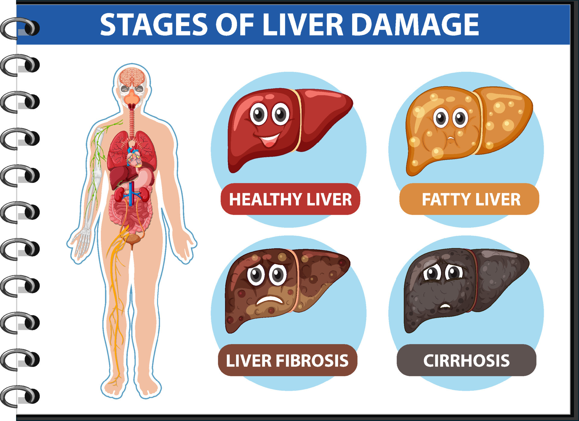 Diagram showing stages of liver damage 6154055 Vector Art at Vecteezy