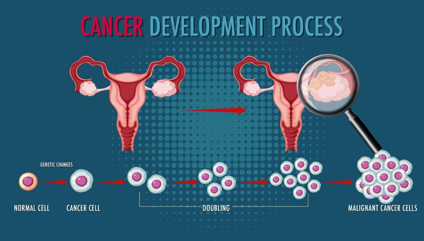 infografía del proceso de desarrollo del cáncer vector