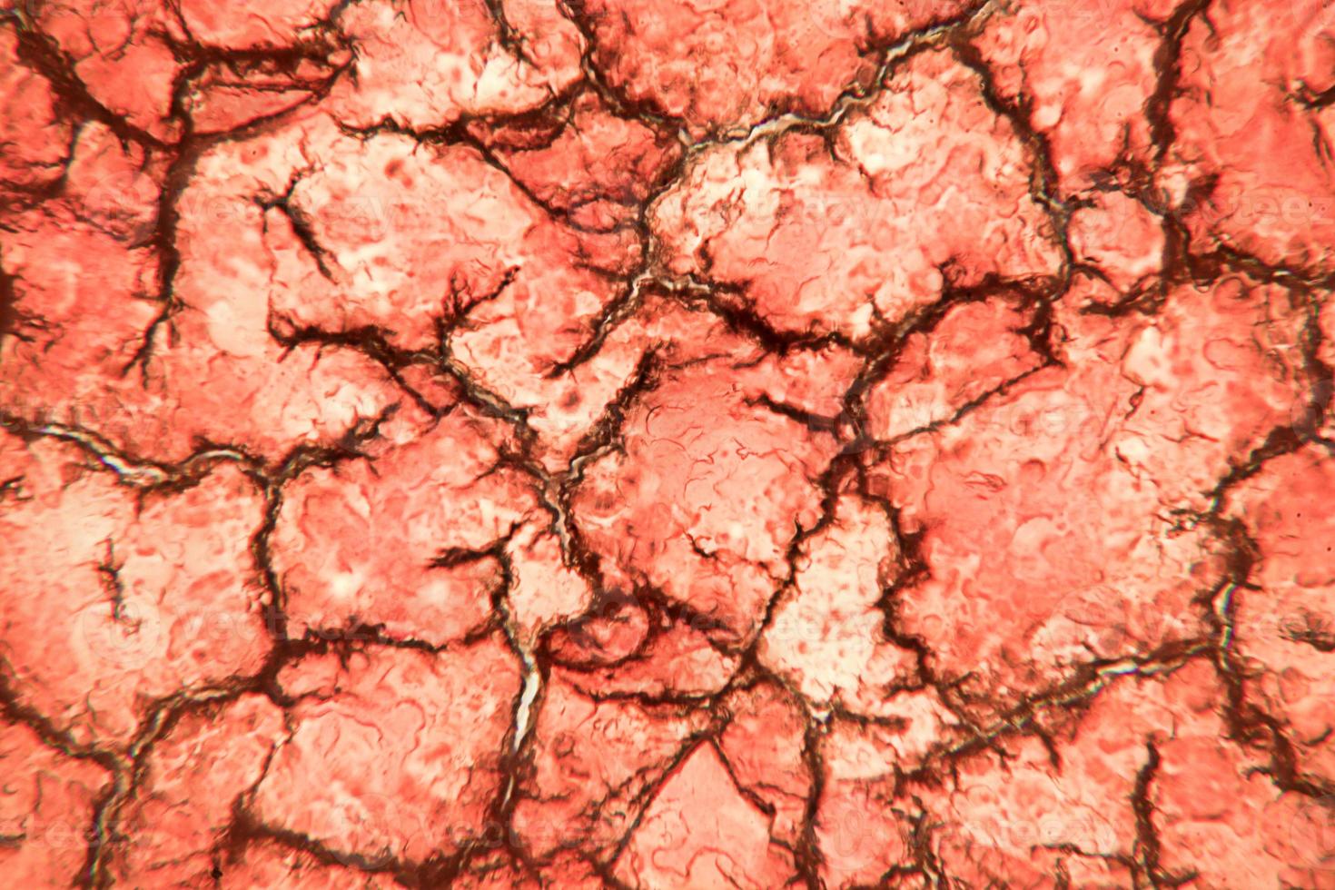 Solidified coagulated blood seen on a 100x microscope view. Blood smear under microscope present neutrophils and red blood cells photo