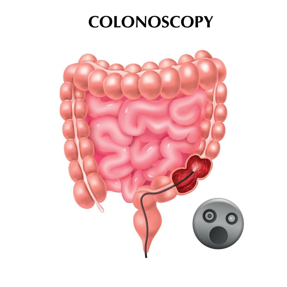 cartel realista de colonoscopia vector