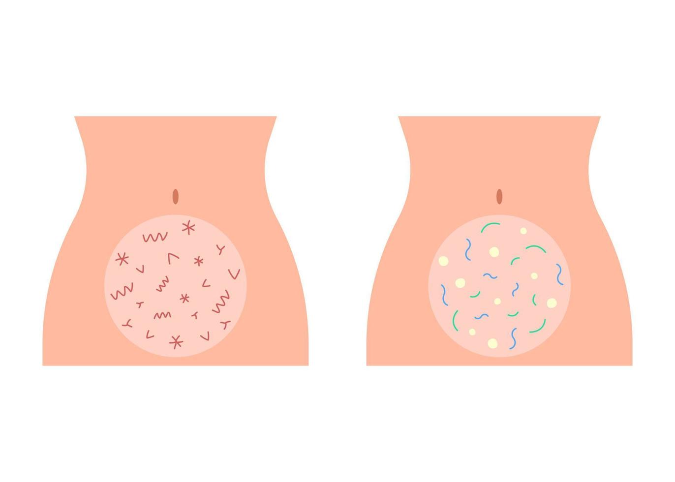 Buena microflora sana y mala del dolor en el intestino del abdomen. digestión intestinal. figura corporal femenina con bacterias dañinas y beneficiosas. ilustración vectorial vector