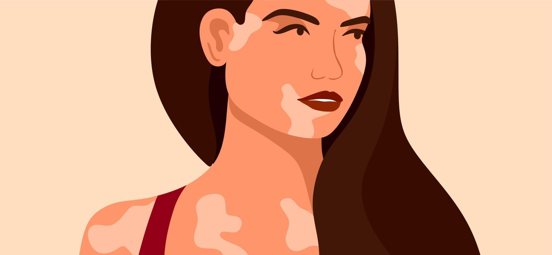 Vitiligo is a young woman with skin problems. Skin diseases. The concept of World Vitiligo Day. Different skin colors of female characters. For a blog, articles, banner, magazine. vector