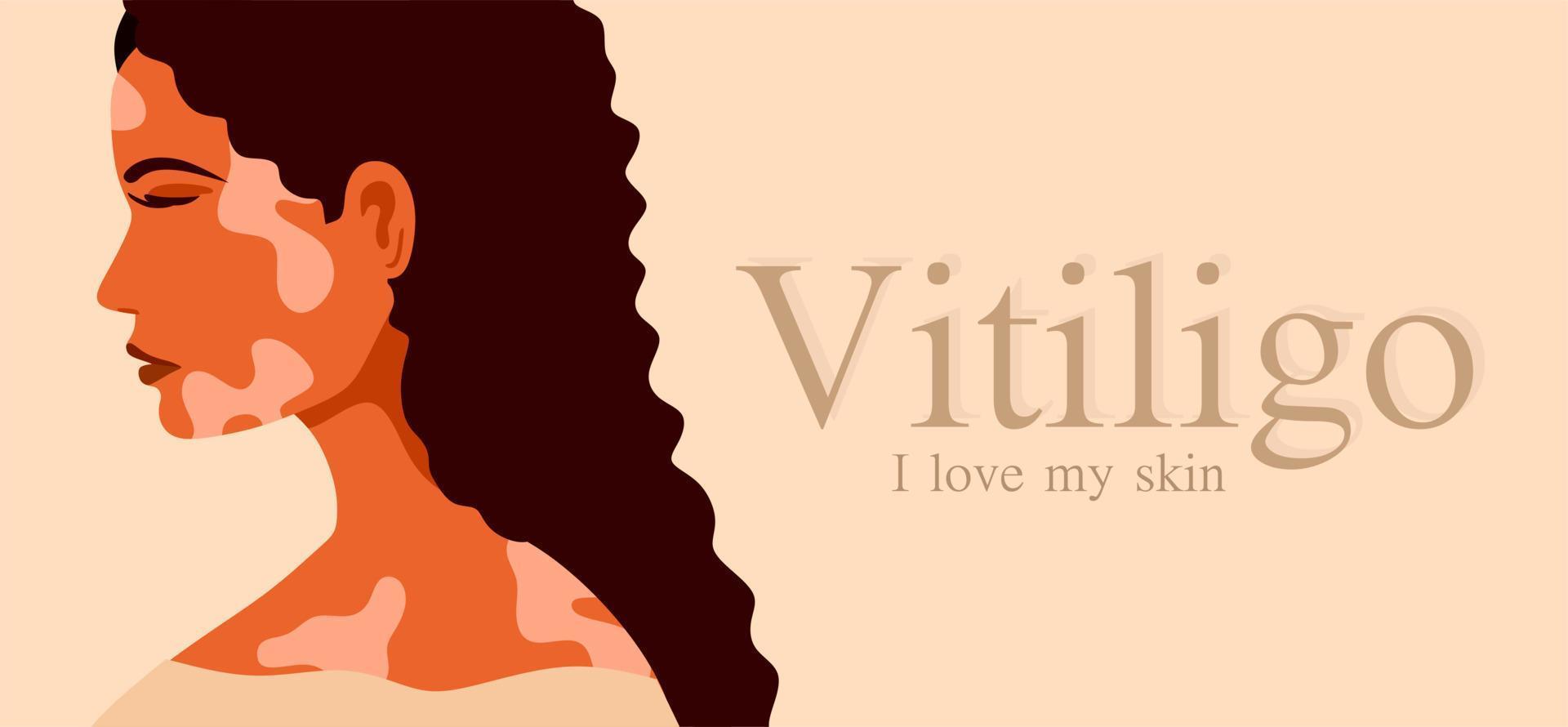 vitíligo es una mujer joven con problemas en la piel. Enfermedades de la piel. el concepto del día mundial del vitíligo. diferentes colores de piel de personajes femeninos. para un blog, artículos, banner, revista. vector