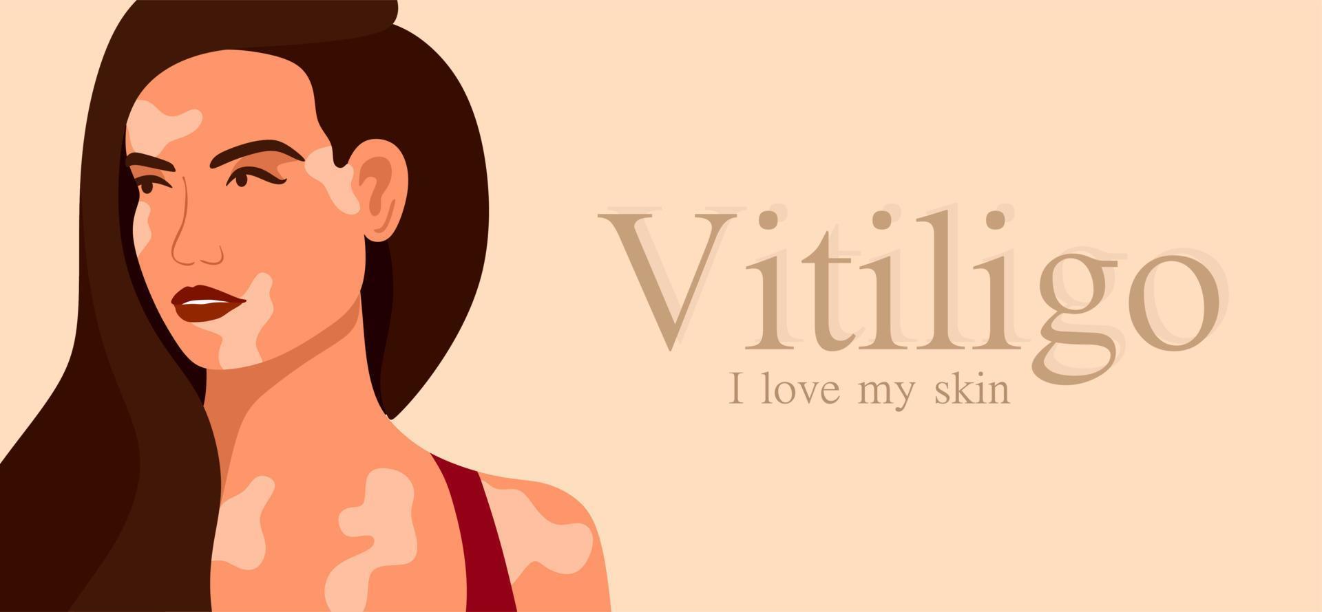 vitíligo es una mujer joven con problemas en la piel. Enfermedades de la piel. el concepto del día mundial del vitíligo. diferentes colores de piel de personajes femeninos. para un blog, artículos, banner, revista. vector