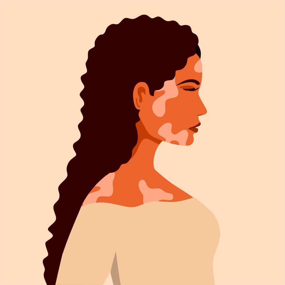 vitíligo es una mujer joven con problemas en la piel. Enfermedades de la piel. el concepto del día mundial del vitíligo. diferentes colores de piel de personajes femeninos. para un blog, artículos, banner, revista. vector