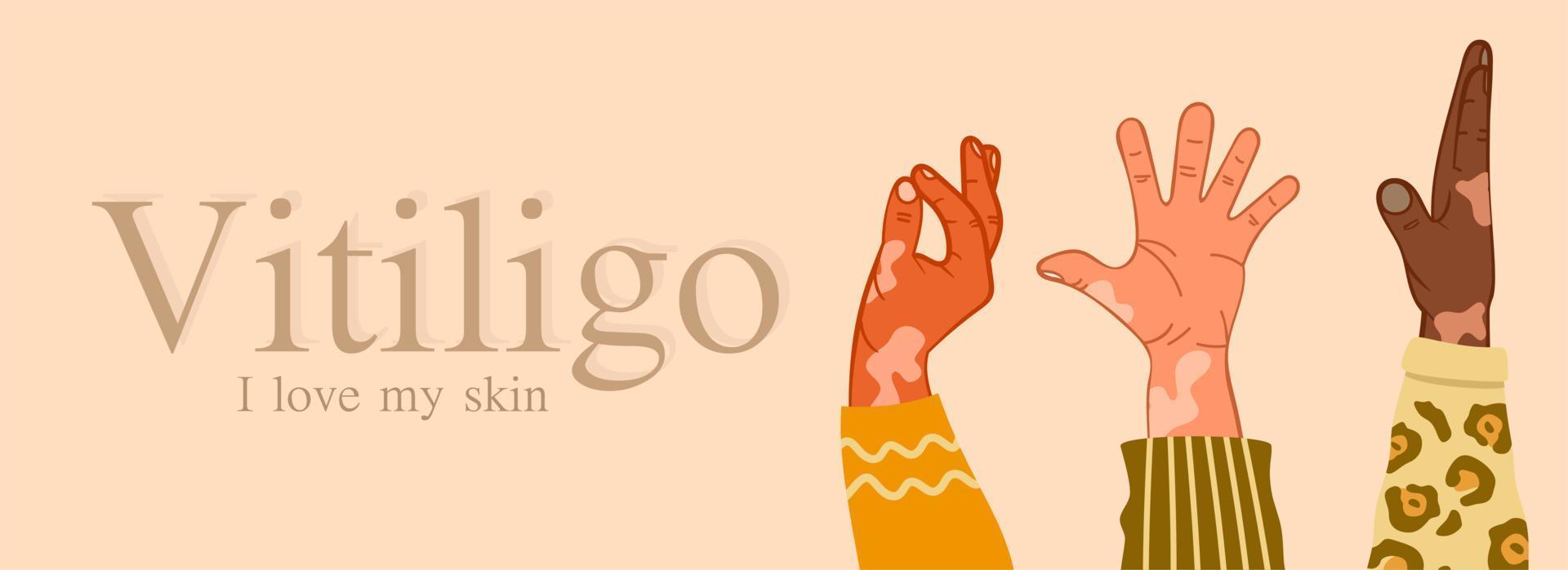 vitiligo tres manos de diferentes razas con problemas de piel. Enfermedades de la piel. el concepto del día mundial del vitíligo. diferentes colores de piel de personajes femeninos. para un blog, artículos, banner, revista. vector