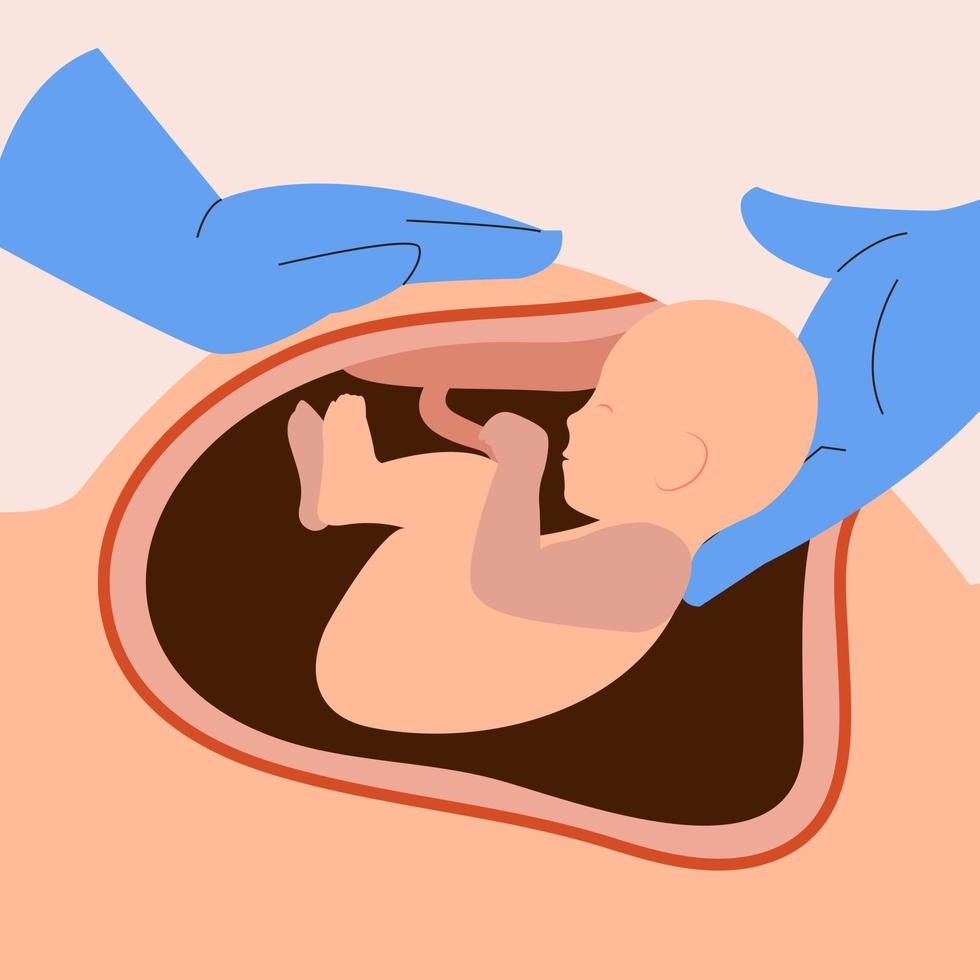Illustration of C-section or cesarean process vector