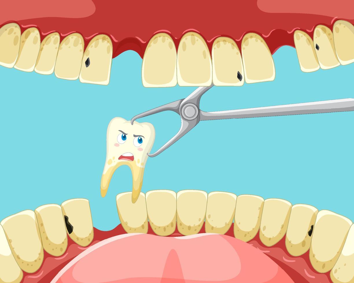 Tooth extraction inside human mouth vector