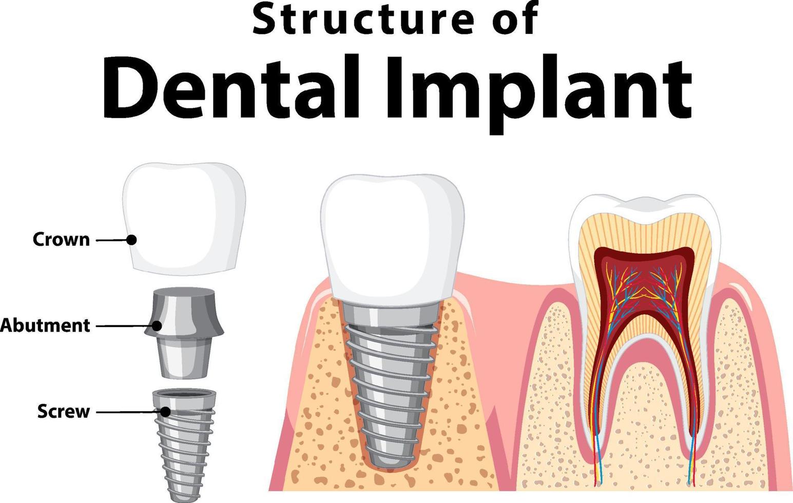 Structure of the dental implant on white background vector