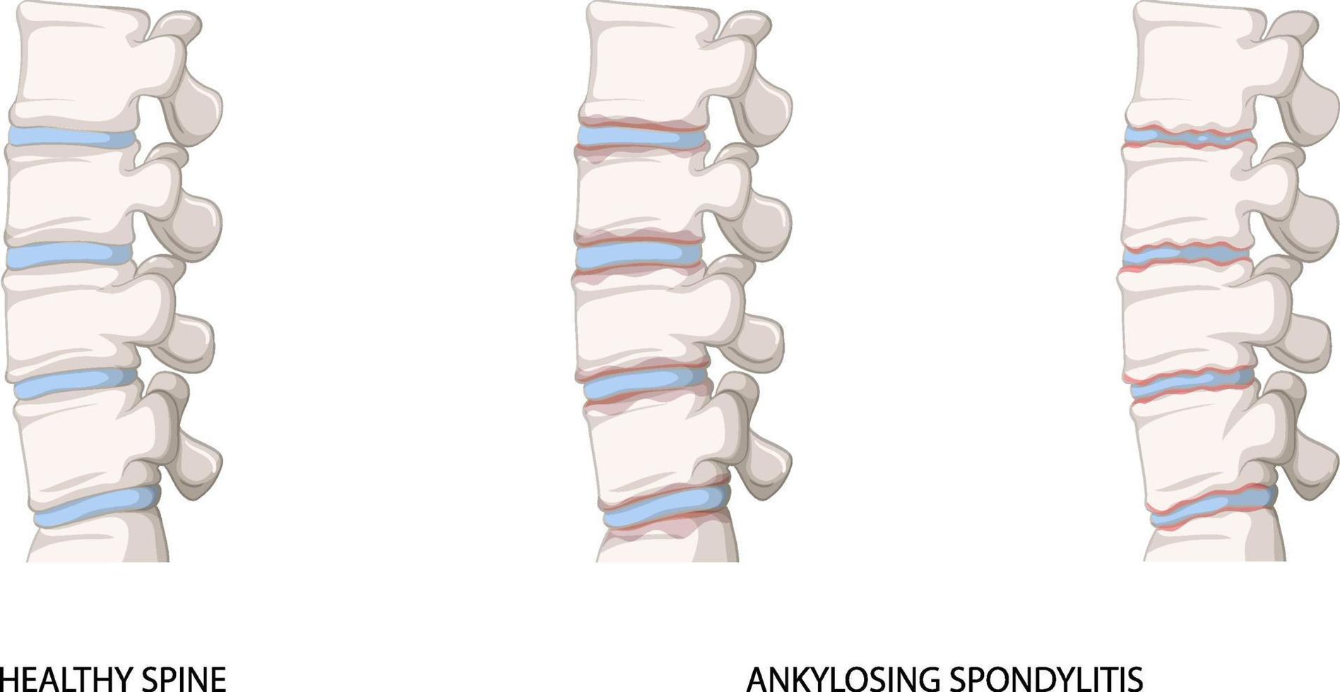 infografía de columna sana y espondilitis anquilosante vector