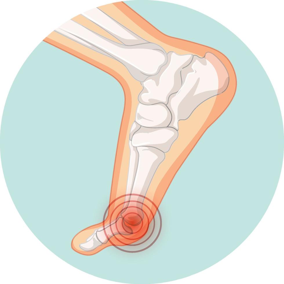 tipos de hallux valgus en plantilla de círculo vector