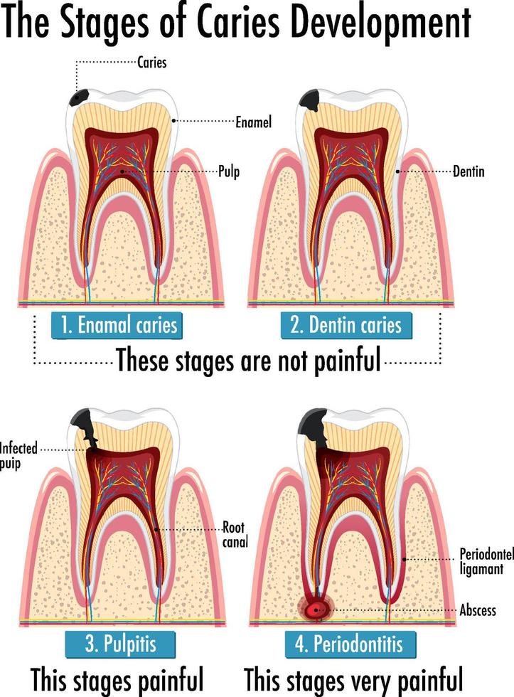 infografía de humanos en etapas de desarrollo de caries vector