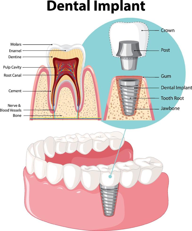 Infographic of human in structure of the dental implant vector