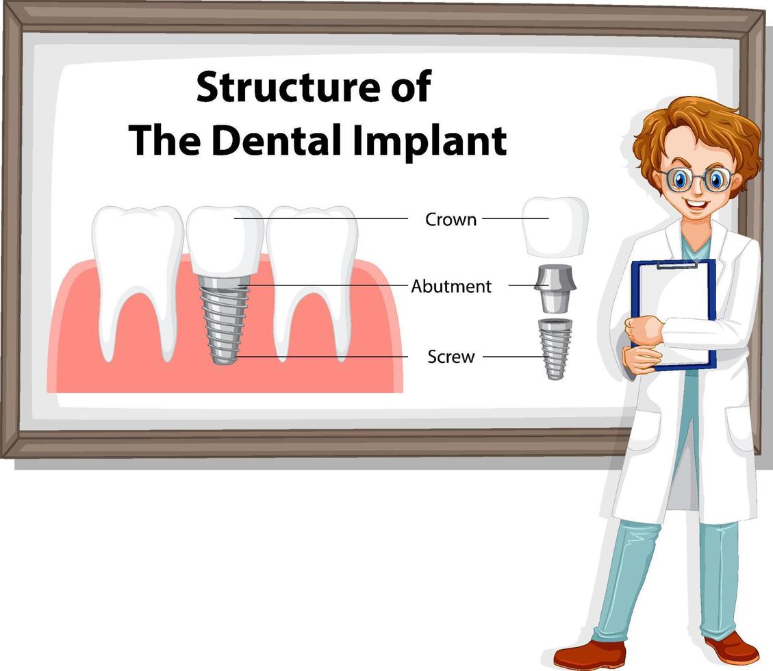 infografía de humanos en la estructura del implante dental. vector