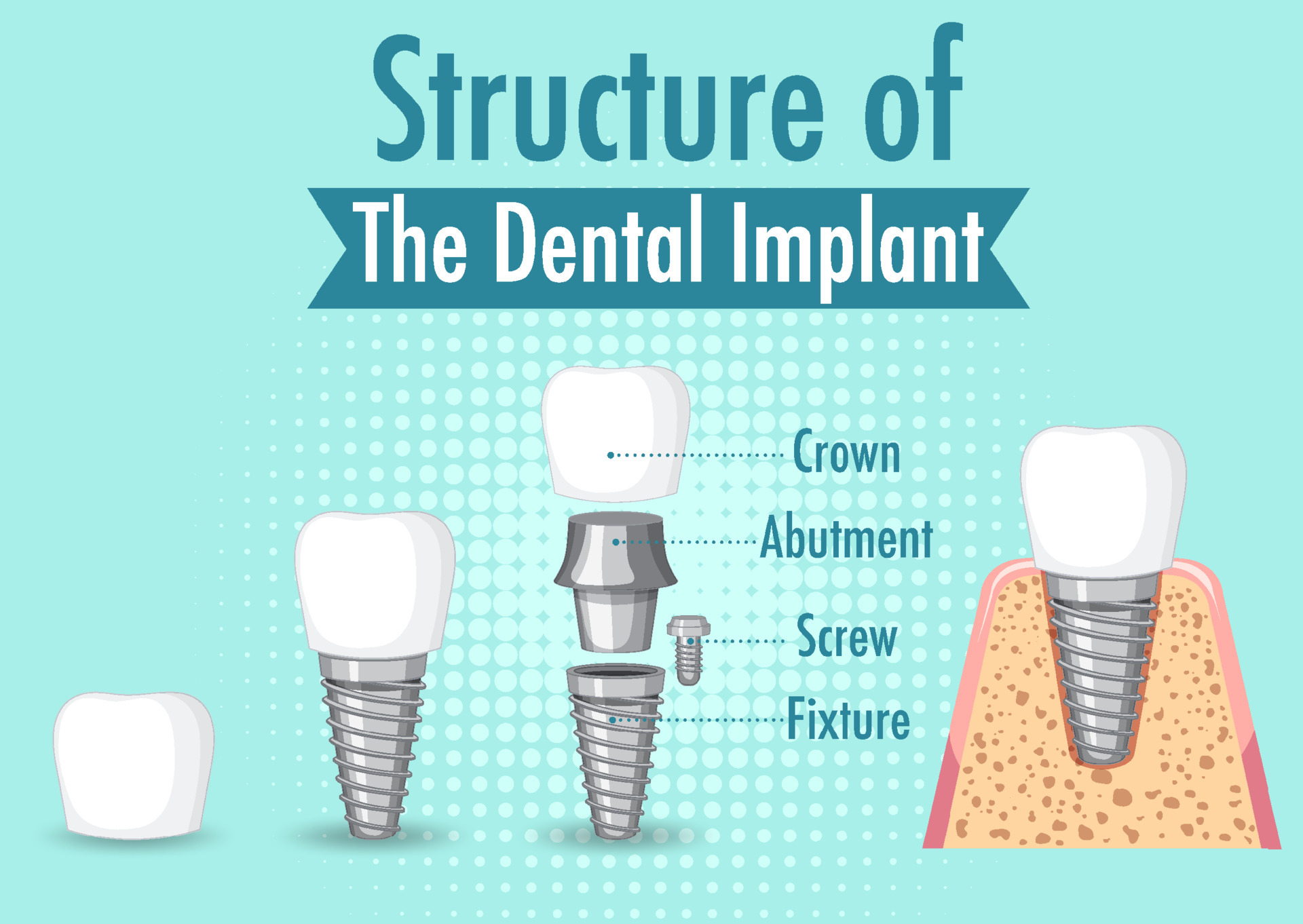 Cuantos implantes dentales se pueden poner en un dia