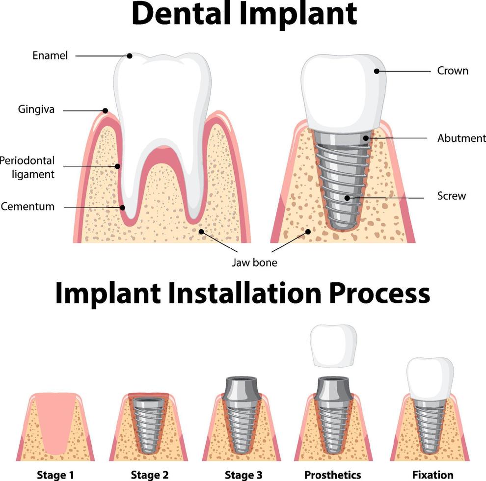 Infographic of human in structure of the dental implant vector