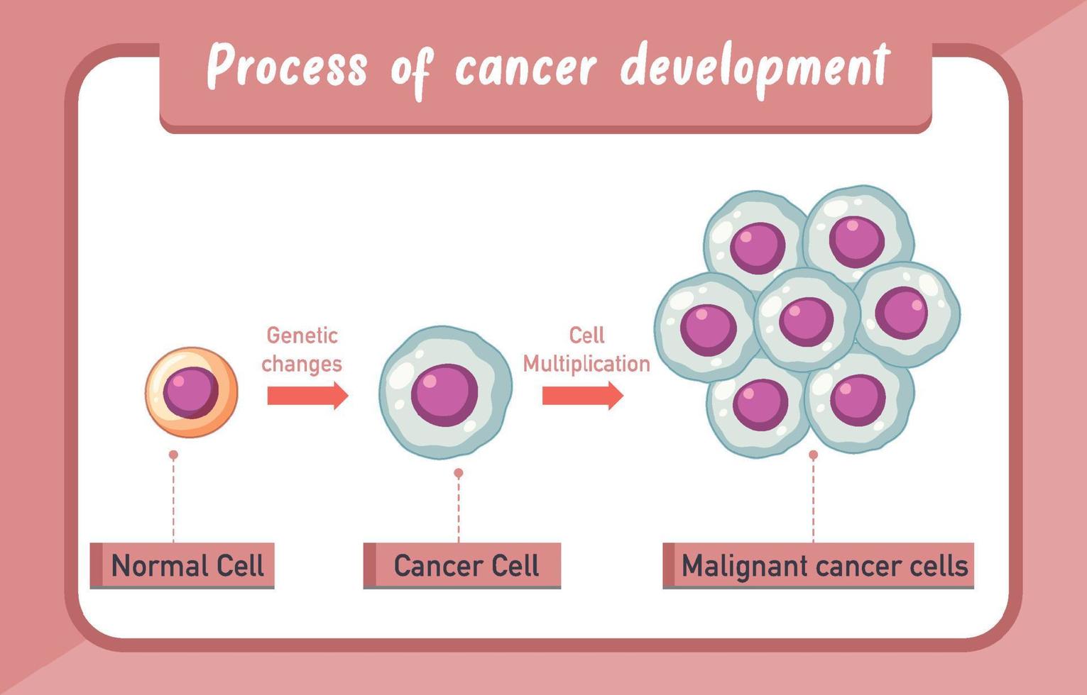 Infografía del proceso de desarrollo del cáncer. vector