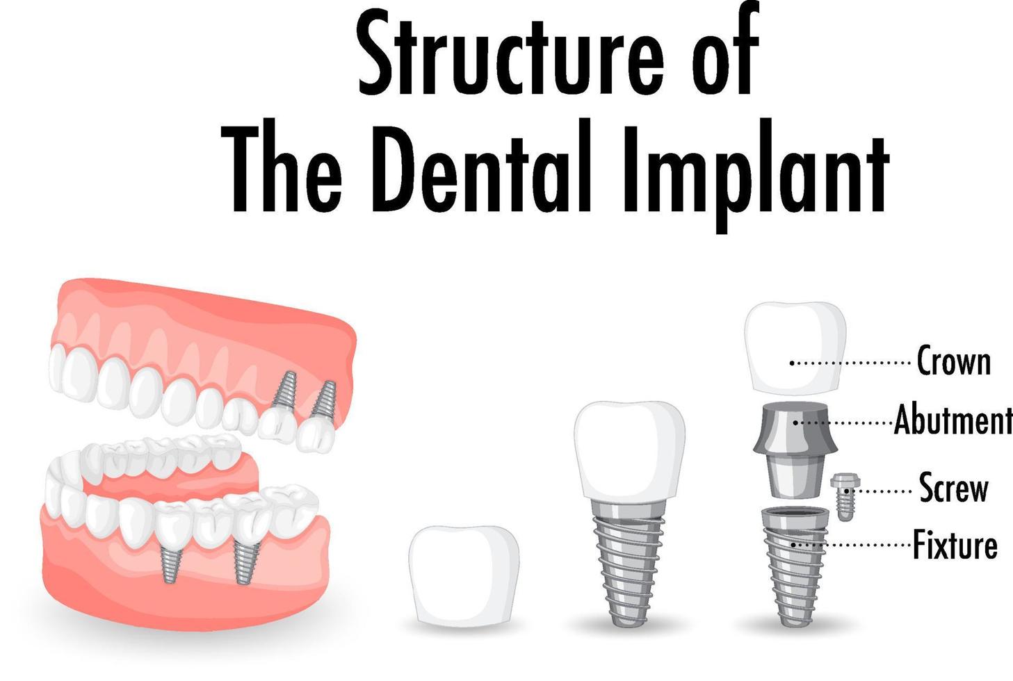 infografía de humanos en la estructura del implante dental. vector