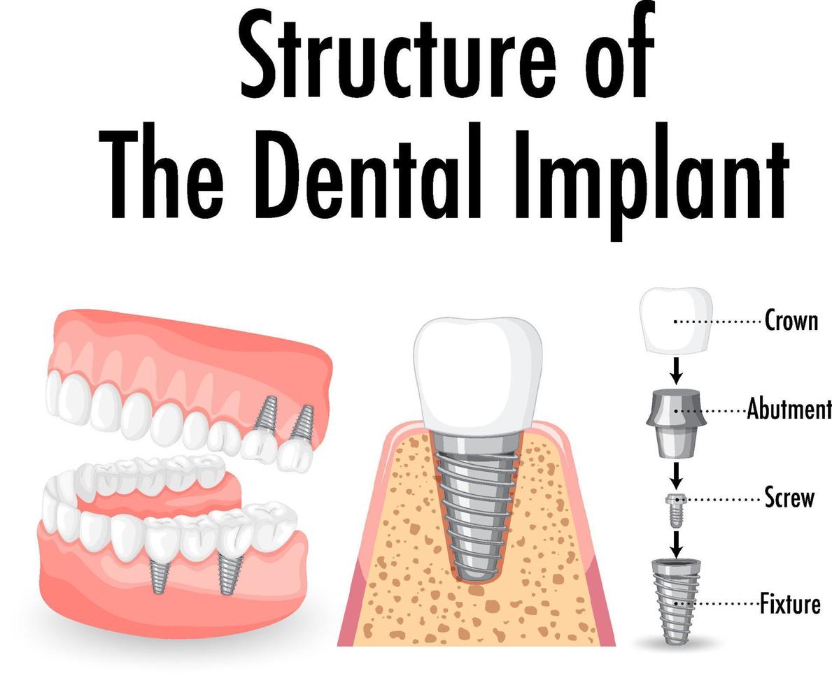 Infographic of human in structure of the dental implant vector
