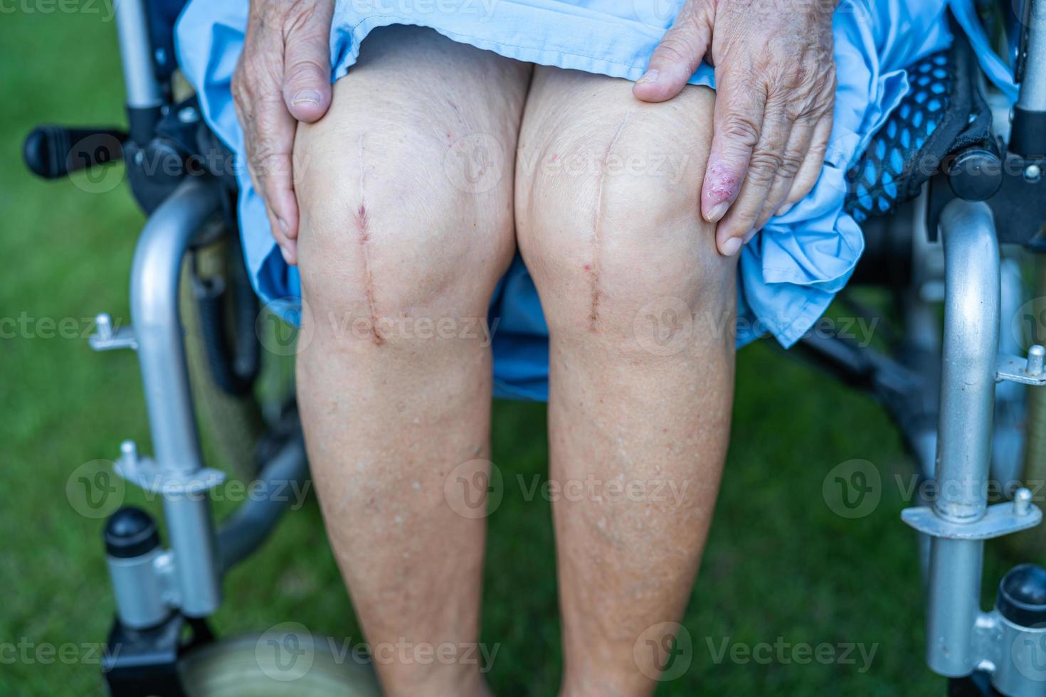 paciente asiático mayor o anciana mujer muestra sus cicatrices quirúrgico reemplazo total de la articulación de la rodilla sutura herida cirugía artroplastia en la cama en la sala del hospital de enfermería, concepto médico fuerte y saludable. foto