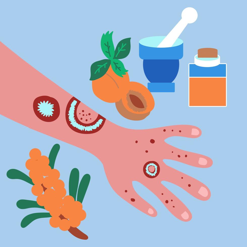 Treatment of psoriasis and eczema at home. Apricot, sea buckthorn oil medicated oils vector