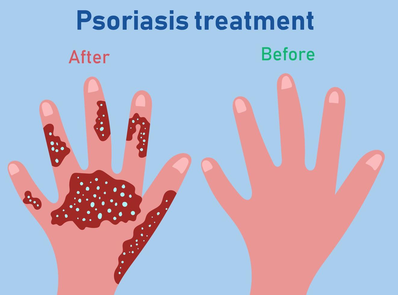 Etapas de formación de la psoriasis. tratamiento de la psoriasis antes y despues vector