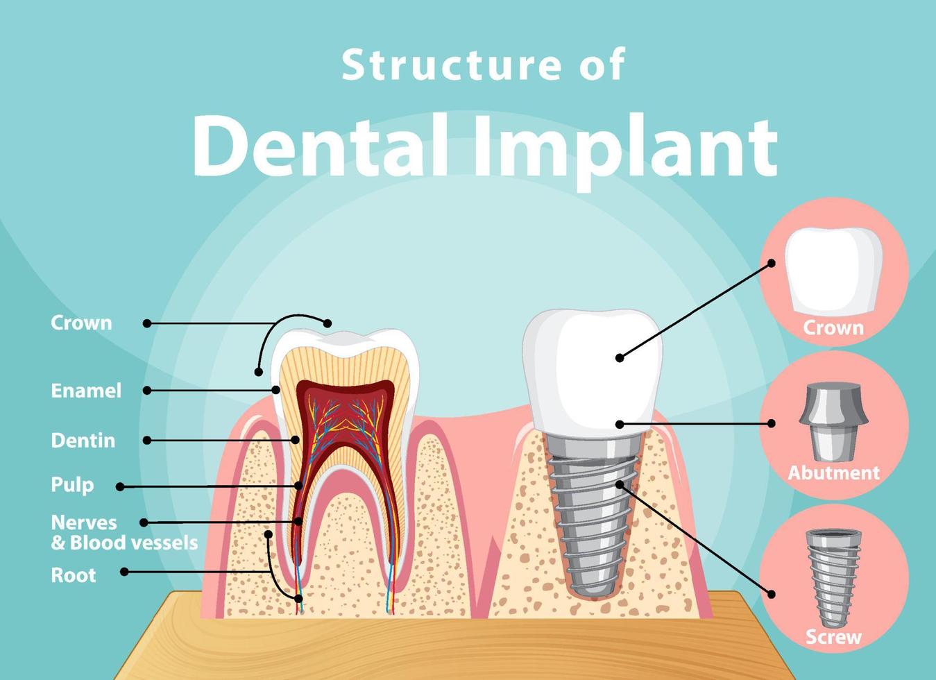 infografía de humanos en la estructura del implante dental. vector