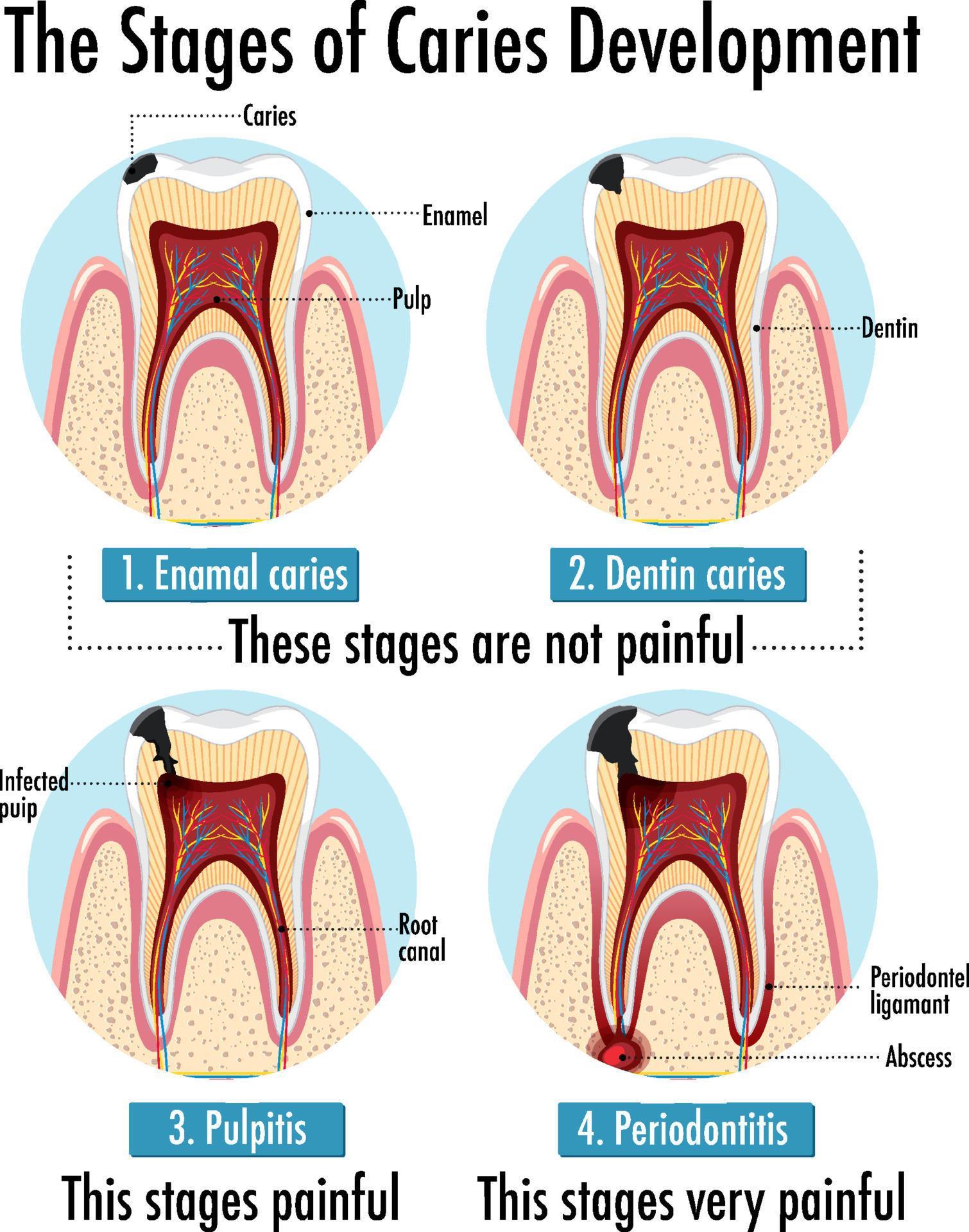 Infographic of human in the stages of caries development 6434683 Vector