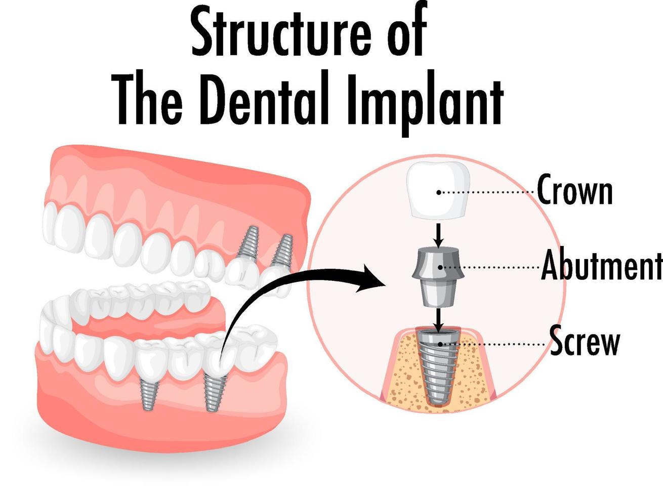 Infographic of human in structure of the dental implant vector