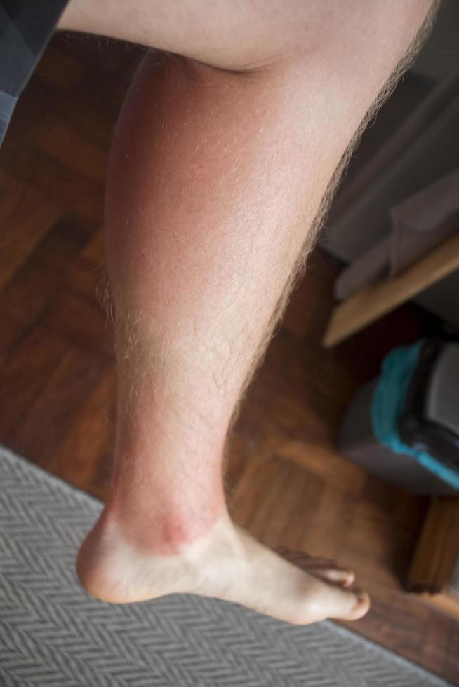 Red burned leg from the sun. photo