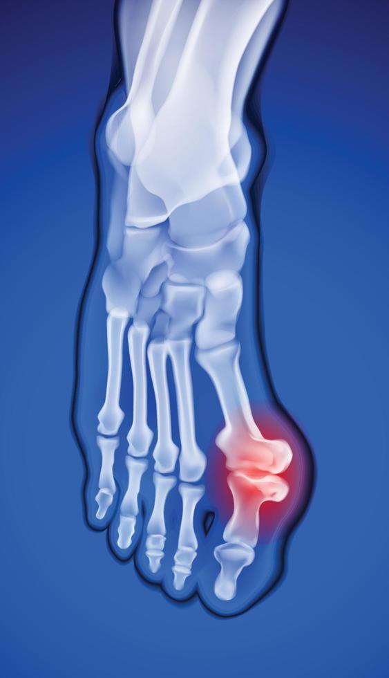 X-ray of the foot with an abnormal bone in the thumb joint that causes severe pain. vector