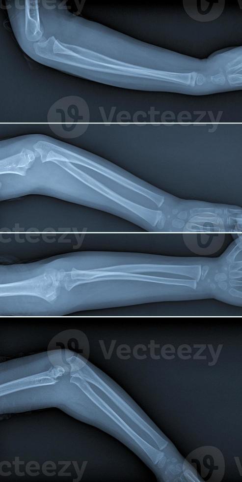 Broken arm xray photo