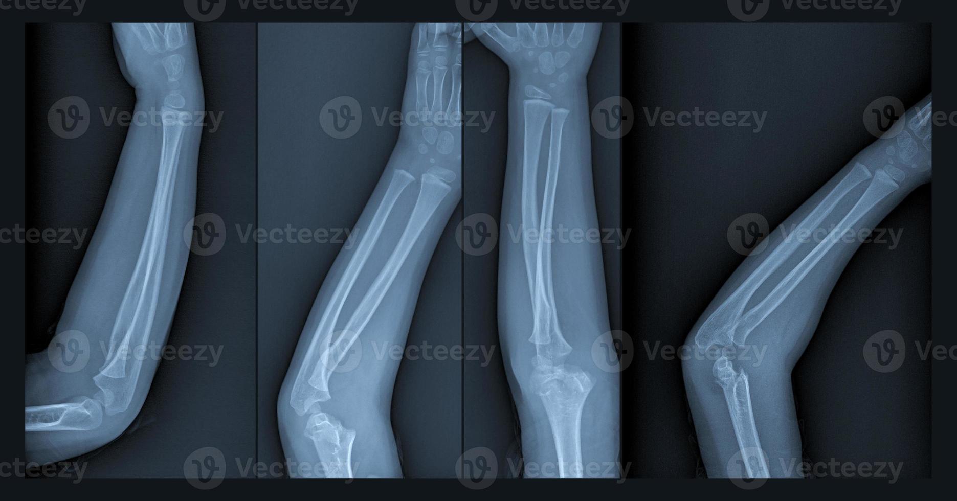 Broken arm xray 6518683 Stock Photo at Vecteezy