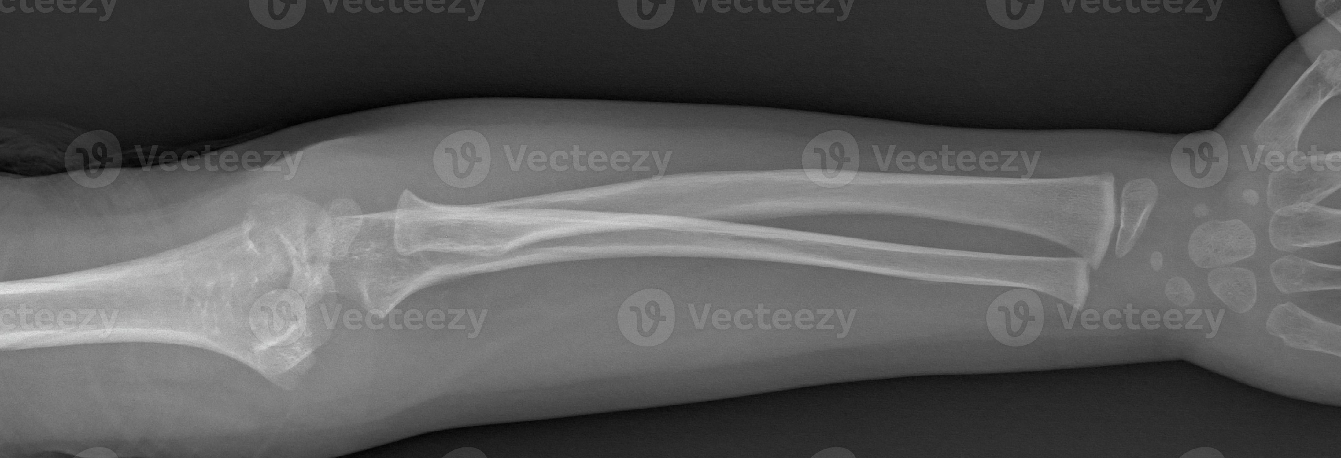 Broken arm xray 6519116 Stock Photo at Vecteezy