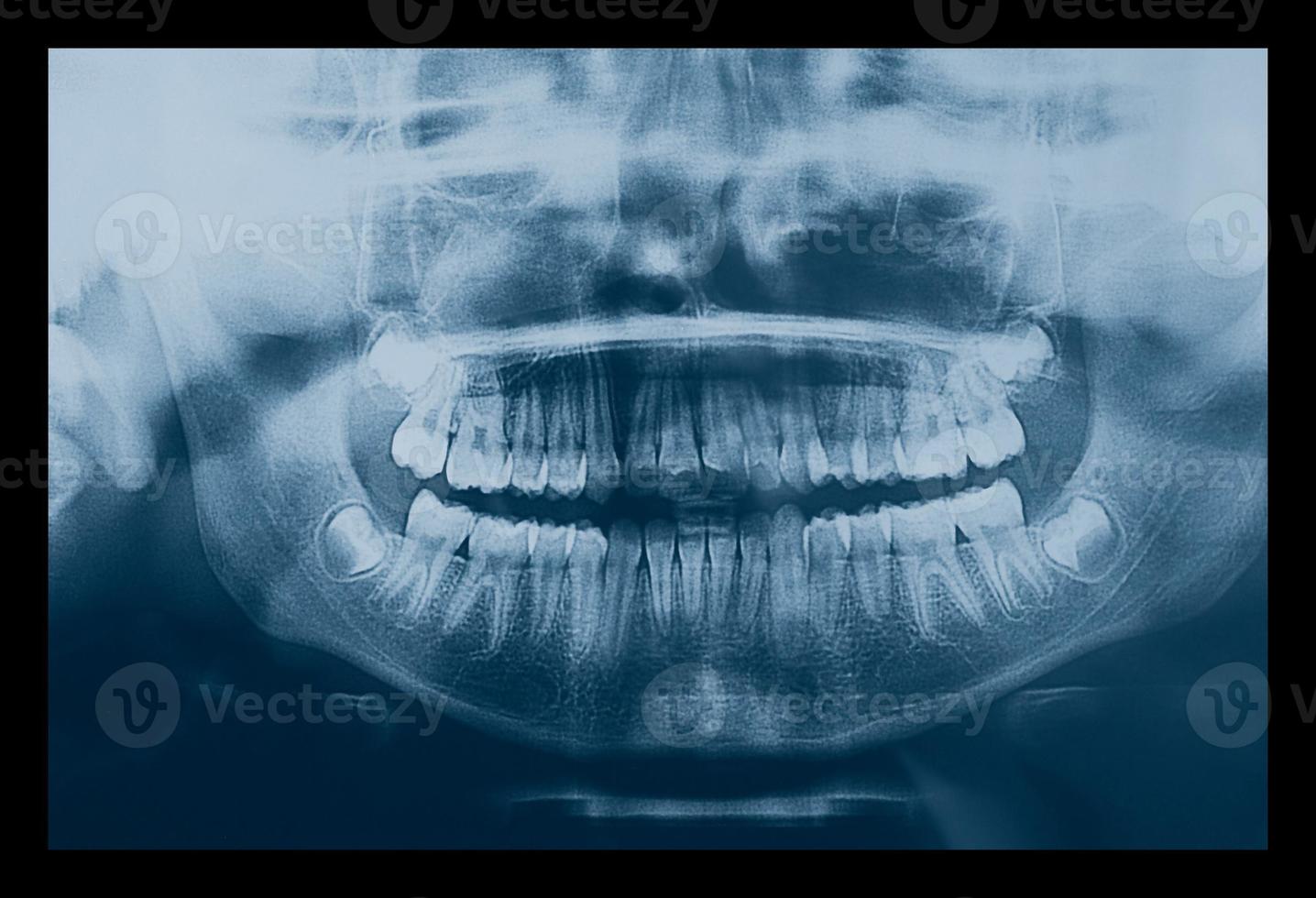 Medical X ray imaging of human teeth of a child photo
