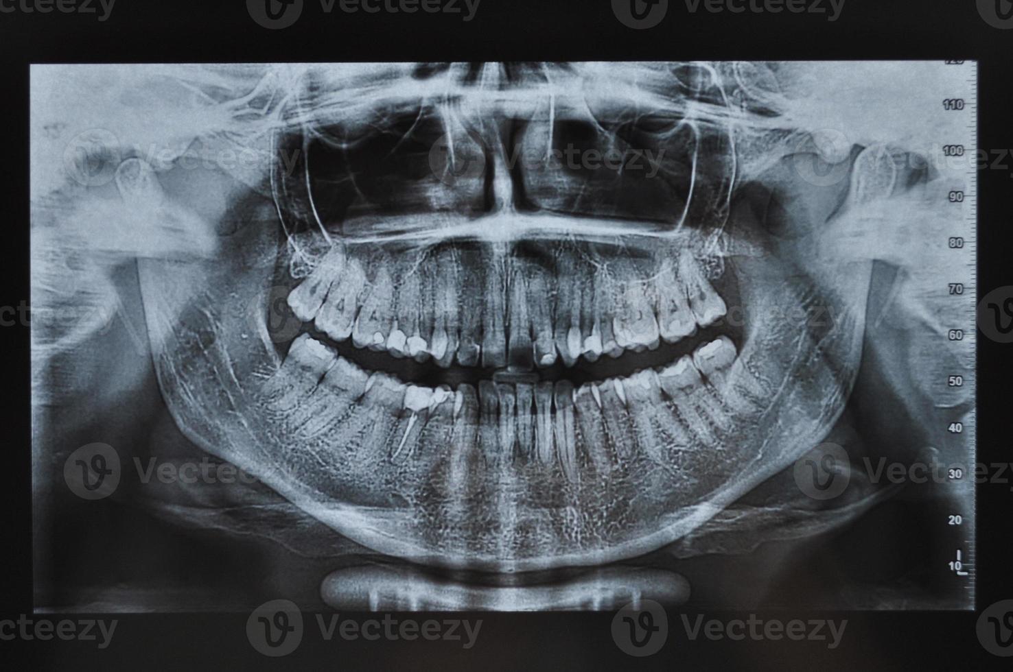radiografía de los dientes de la cara completa foto