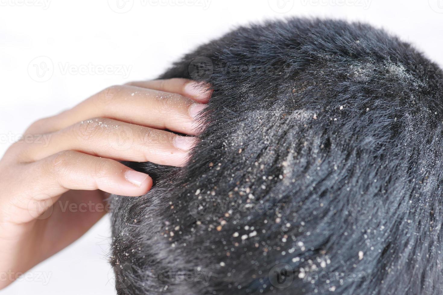 men with dandruff in his hair, closeup photo