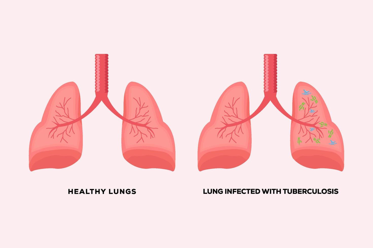 healthy lungs and lungs infected with tuberculosis vector