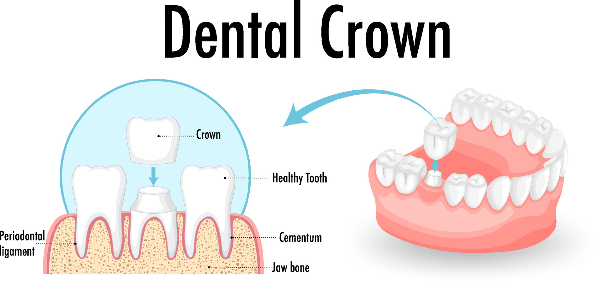 Cuanto cuesta una corona dental Cuanto cuesta una corona dental