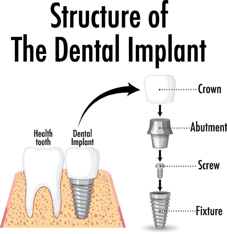 Structure of the dental implant on white background vector