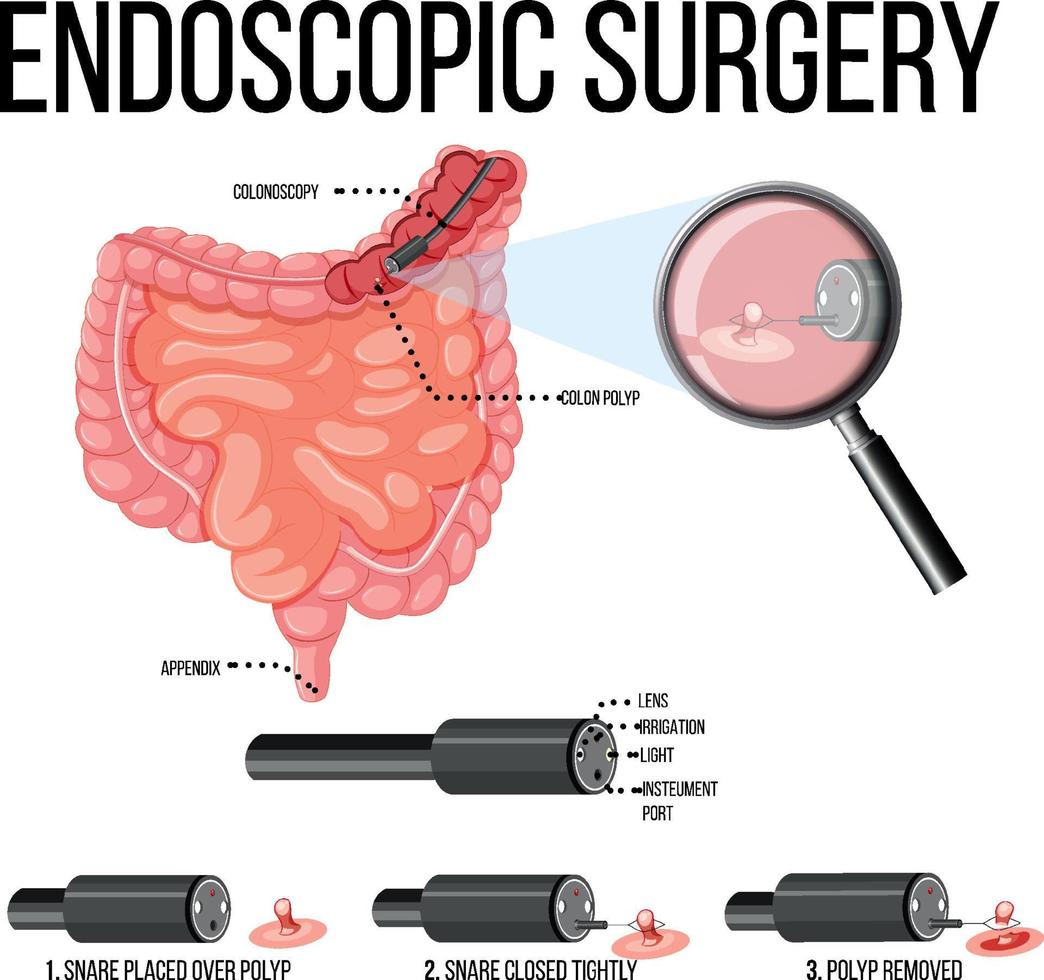 diagrama que muestra la cirugía endoscópica vector