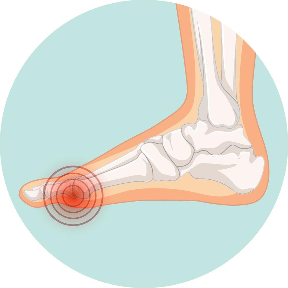 tipos de hallux valgus en plantilla de círculo vector