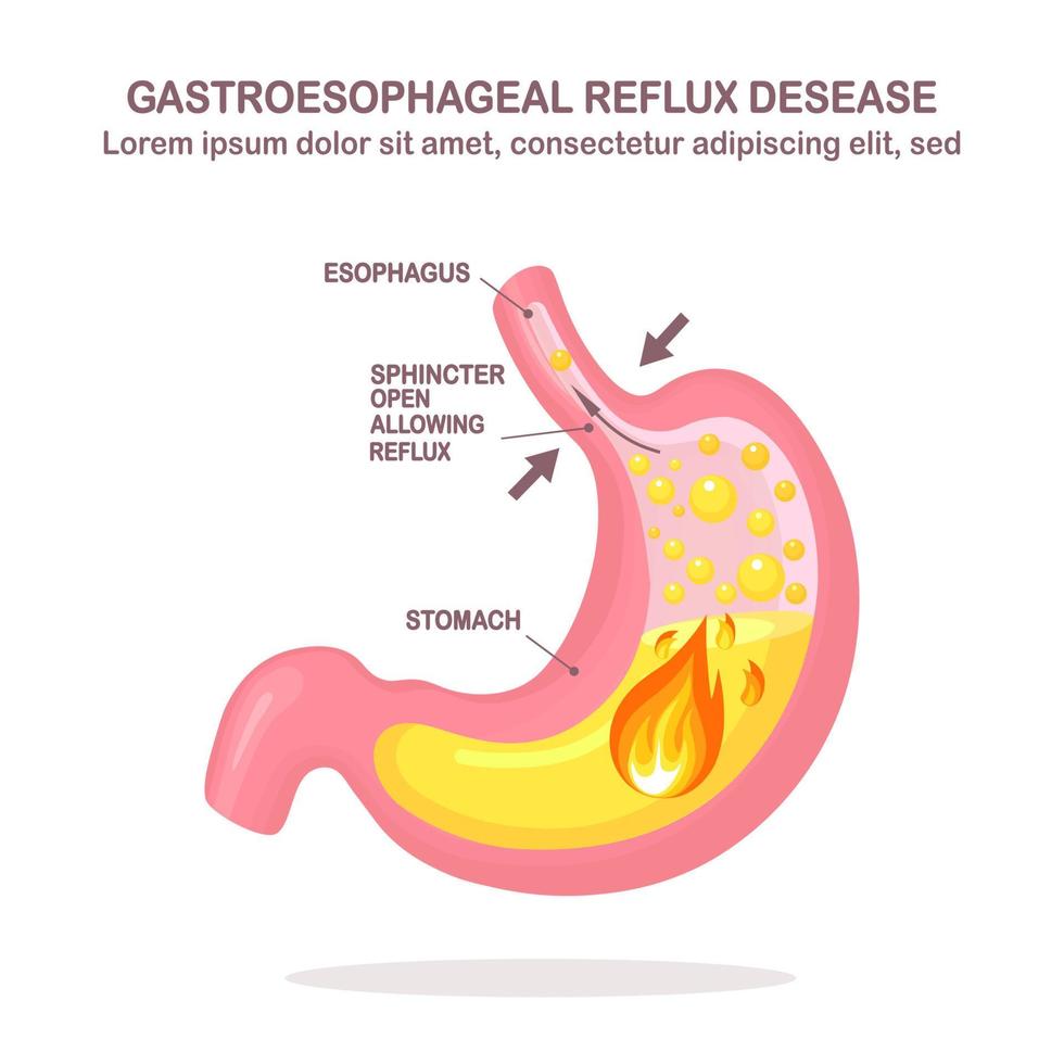 estómago humano enfermedad por reflujo gastroesofágico. gerd, acidez estomacal, infografía gástrica. ácido que asciende hacia el esófago. diseño plano vectorial vector