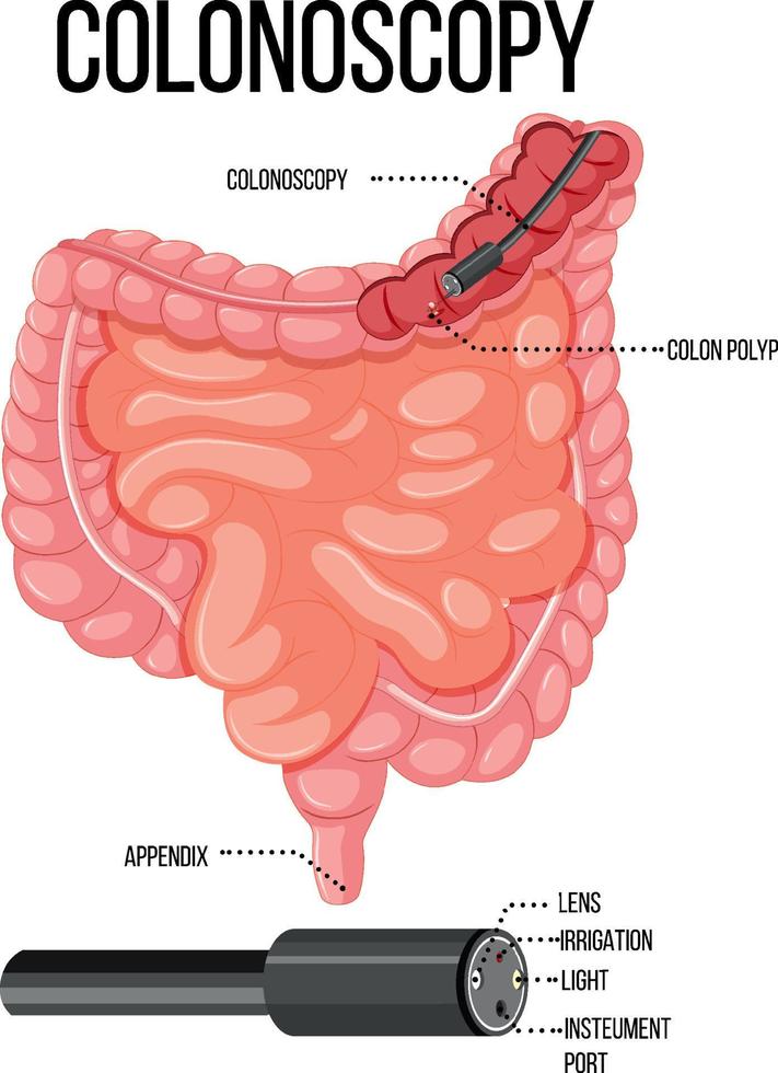 diagrama que muestra la colonoscopia en humanos vector