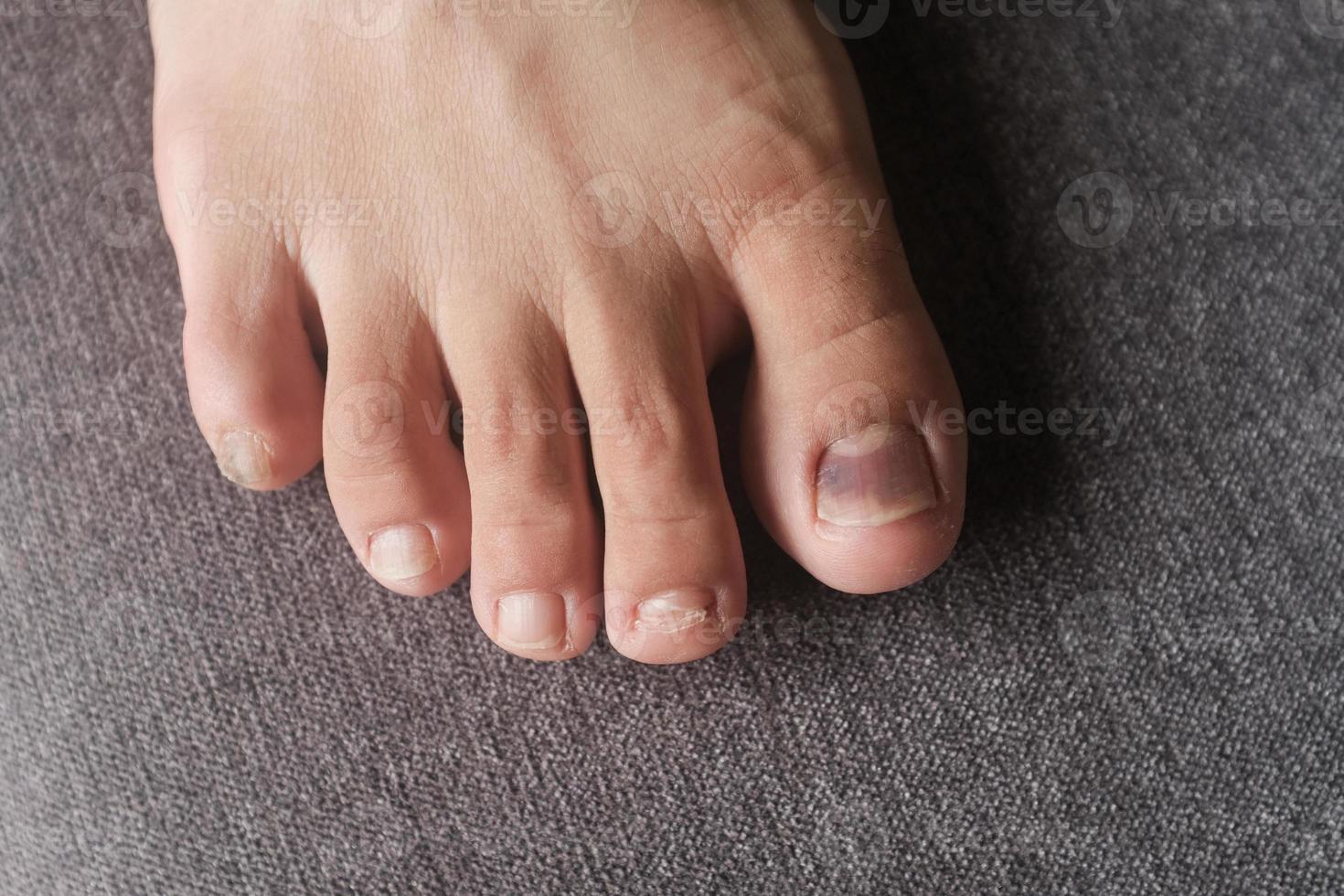 Close up view of a toe nail with purple discoloration due to an injury photo