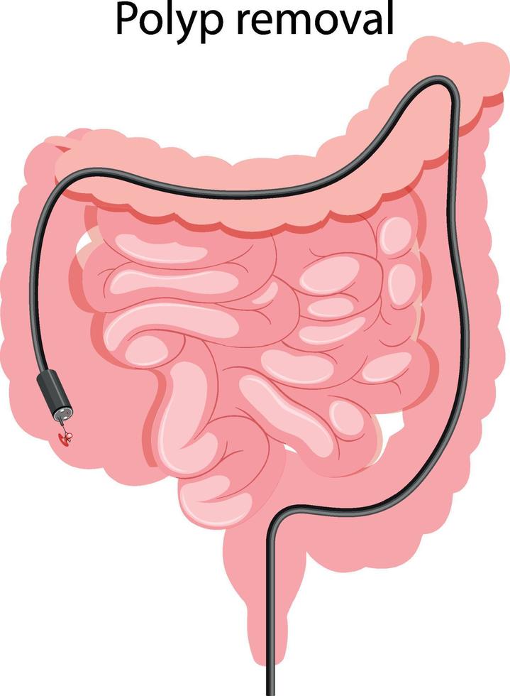 diagrama que muestra la extirpación de pólipos vector