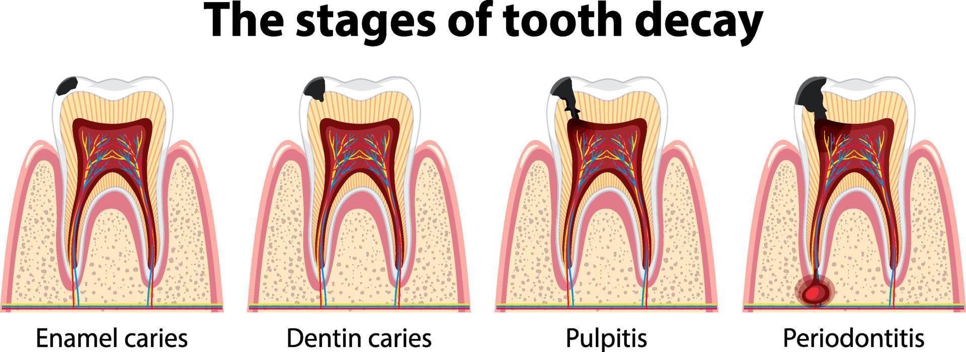 infografía de humanos en las etapas de la caries dental vector