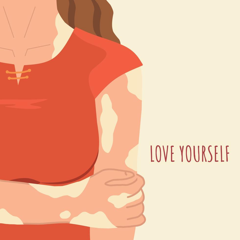 Vector illustration in a flat style. A girl with skin depigmentation. Vitiligo disease. Love yourself.
