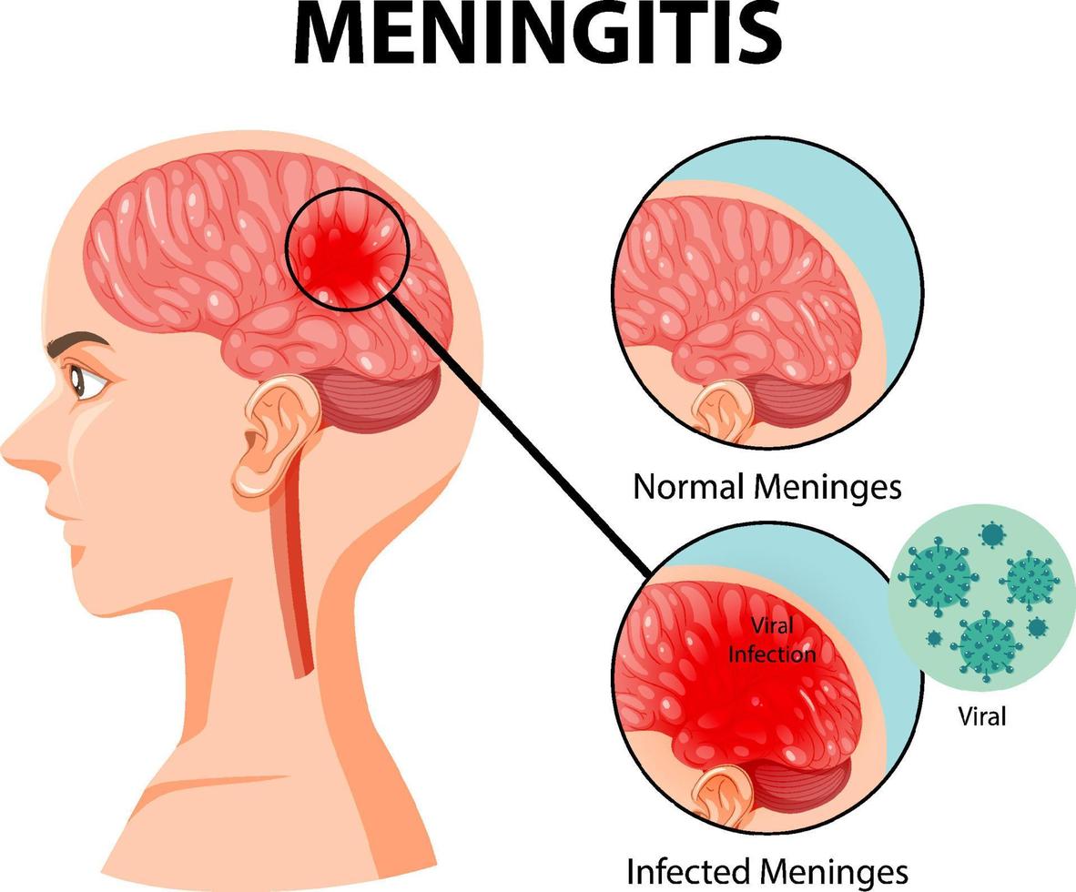 diagrama que muestra la meningitis en el cerebro humano vector