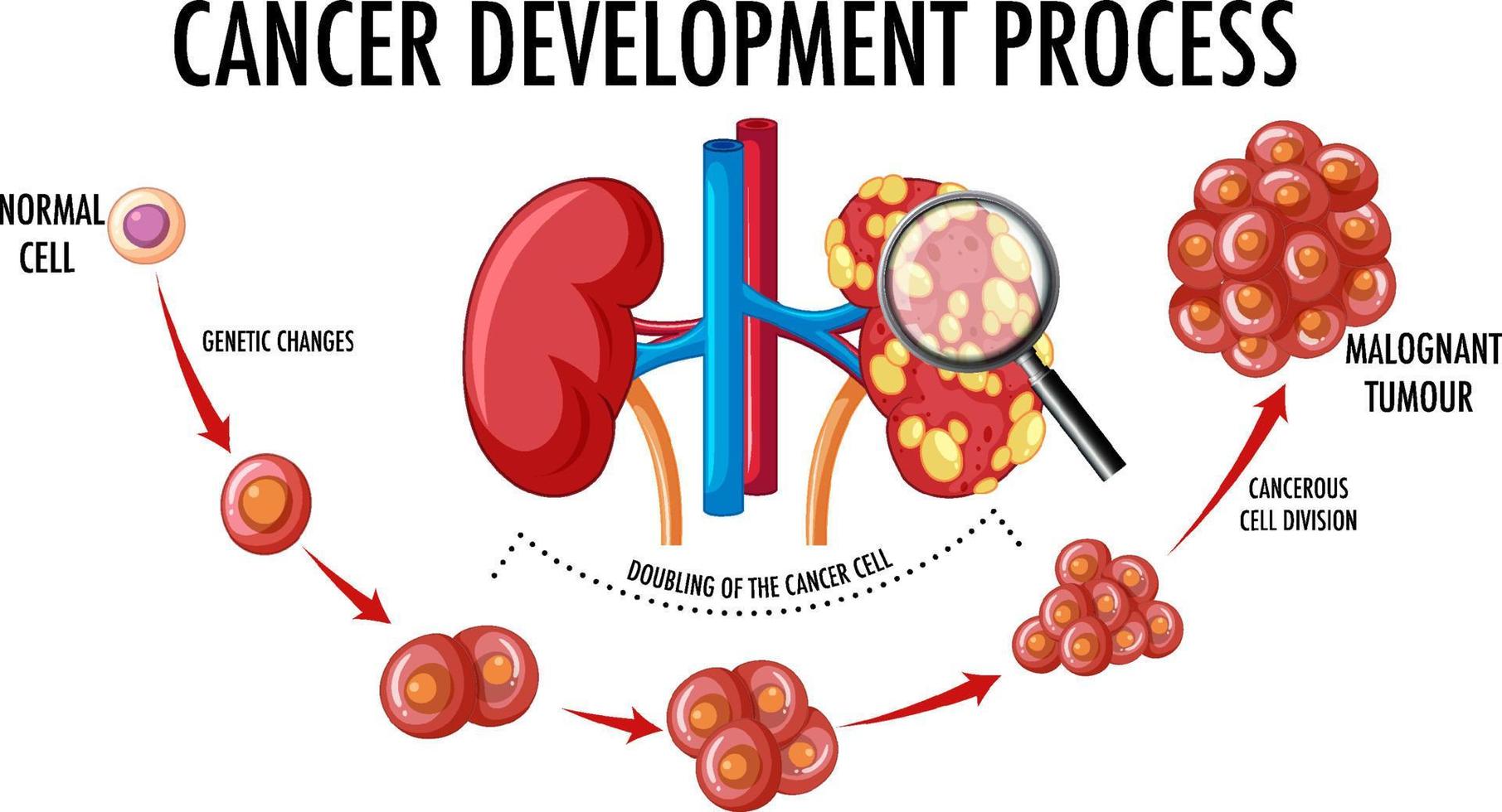 diagrama que muestra el proceso de desarrollo del cáncer vector